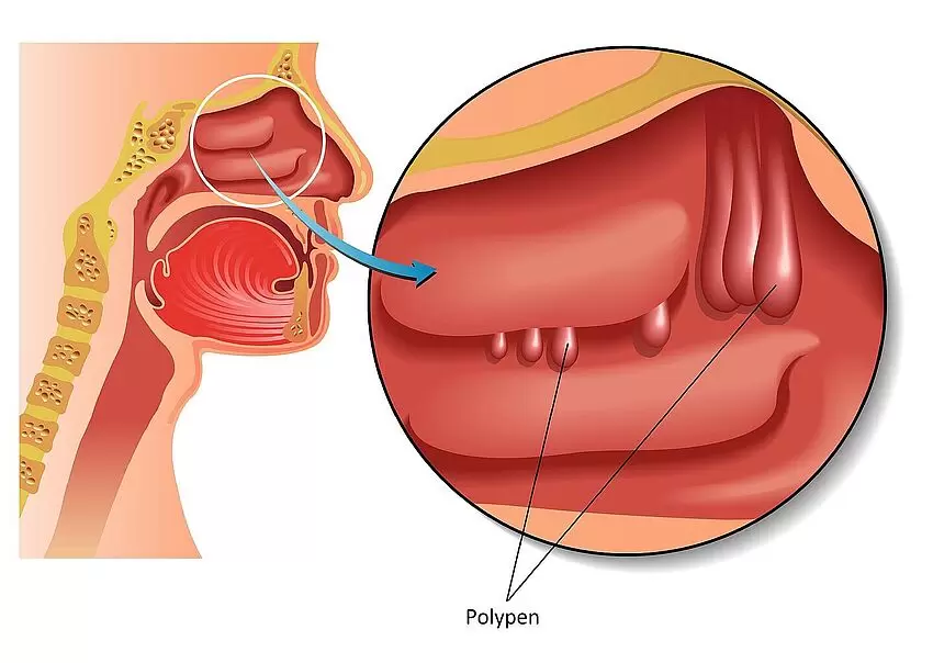 Polypen in der Nase