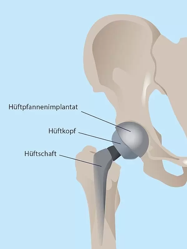 Hüftendoprothetik